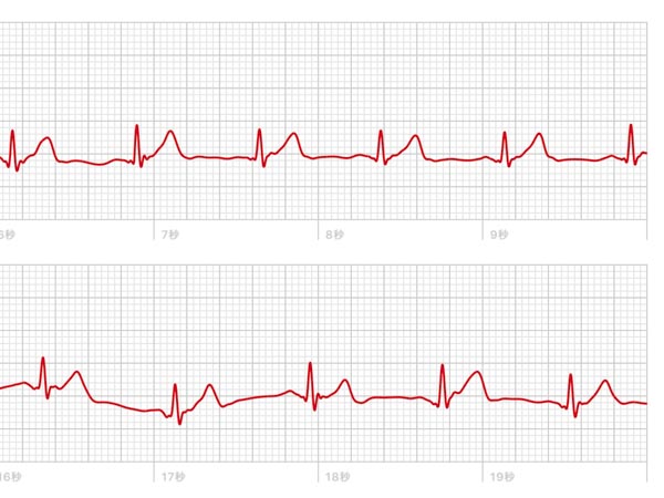 Apple Watchで計測した心電図データ